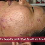 Acne Diet to Reach the zenith of Soft, Smooth and Acne-Free Skin