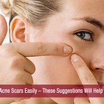 Treat Acne Scars Easily – These Suggestions Will Help You!!