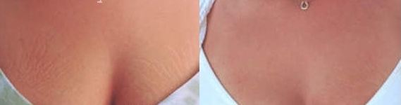 Microdermabrasion for breast stretch marks