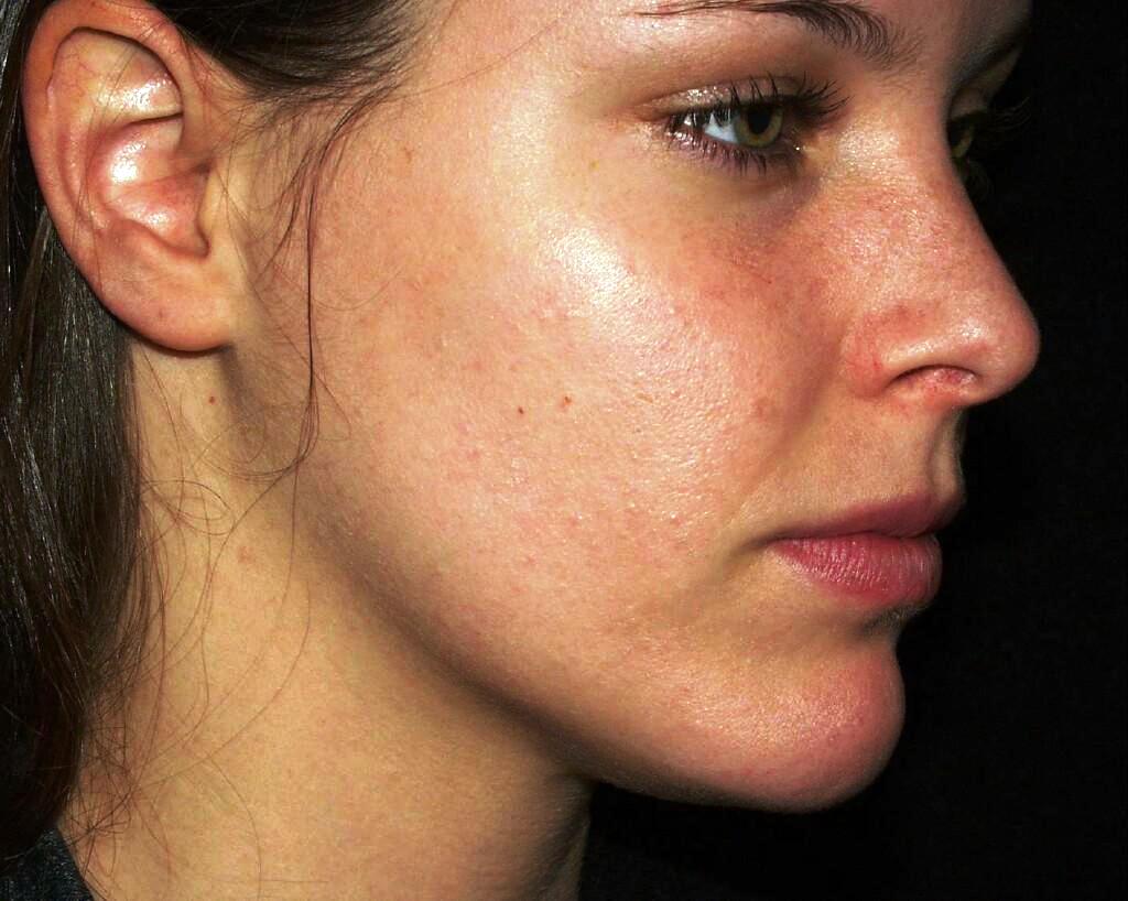 rosacea-cheeks-hd-young-looking-skin-find-out-the-best-way-to-get-beautiful-skin-image