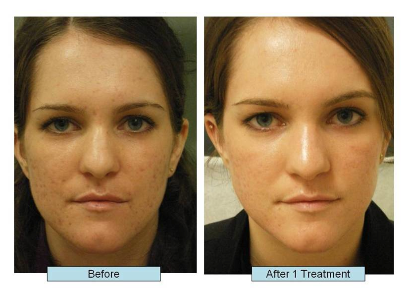 acne-scar-treatment-nyc