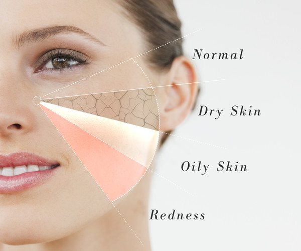 Skin types