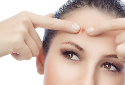 Home Remedies for Pimples  Acne – Acne Scars- All about It