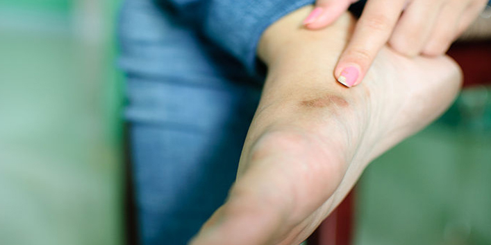Corns-and-Callus