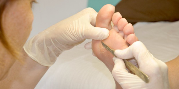 What-you-can-do-to-cure-Corn-or-Callus