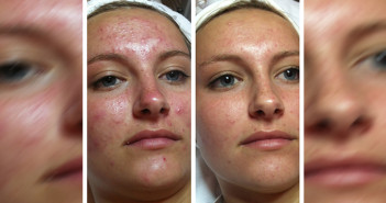 Acne-Facial